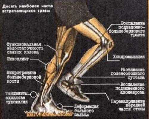 Причины боли в стопе у бегунов после тренировок - livelong