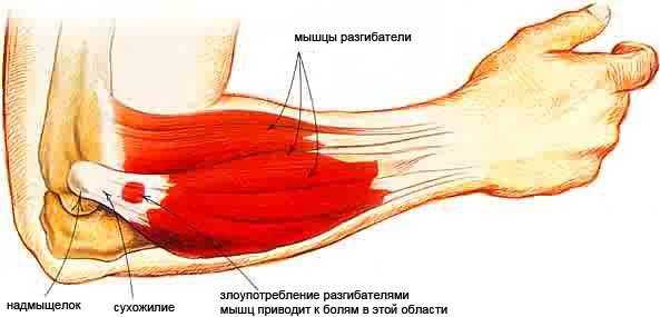 Плечевой сустав боль при поднятии руки: причины, характер, лечение, мази, как избавиться